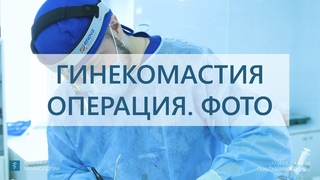 Гинекомастия.  Лечение гинекомастии, операция и результат.