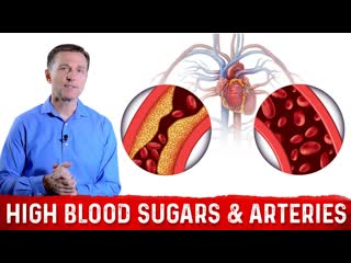 The Effects of High Blood Sugar on Arteries  Dr. Berg on Arteriosclerosis & Atherosclerosis