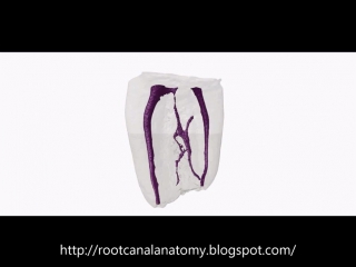 Middle Mesial Canal Mandibular Molar - Prof Marco Versiani (1). Анатомия зубов